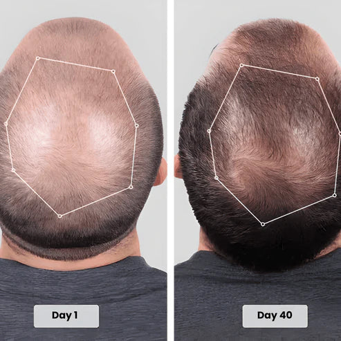 Red Light Therapy Hair Growth Cap